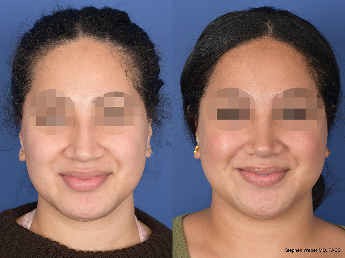 Rhinoplasty Before and After | Weber Facial Plastic Surgery