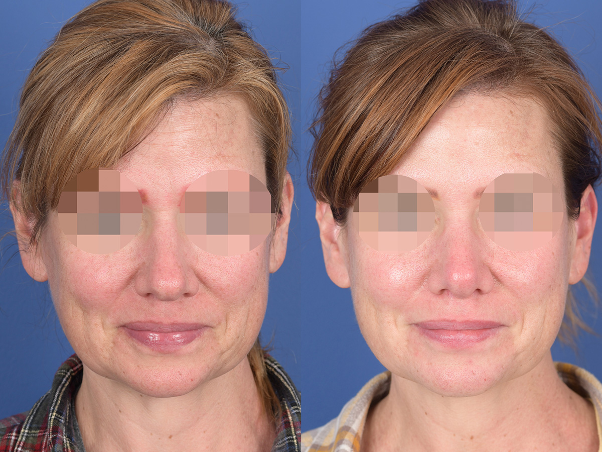 Rhinoplasty Before and After | Weber Facial Plastic Surgery