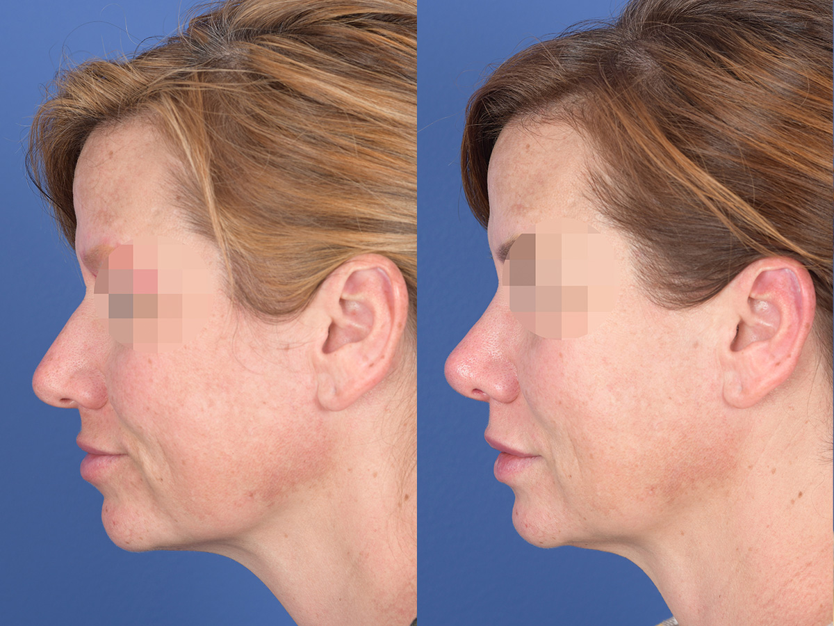 Rhinoplasty Before and After | Weber Facial Plastic Surgery