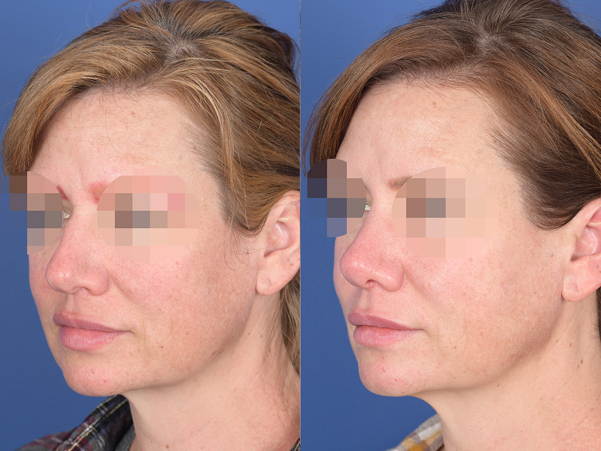 Rhinoplasty Before and After | Weber Facial Plastic Surgery