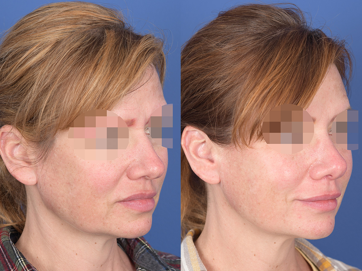 Rhinoplasty Before and After | Weber Facial Plastic Surgery