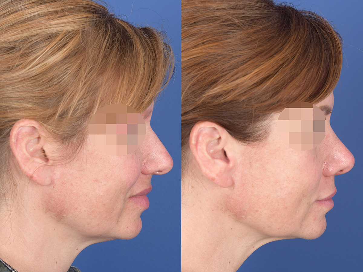 Rhinoplasty Before and After | Weber Facial Plastic Surgery
