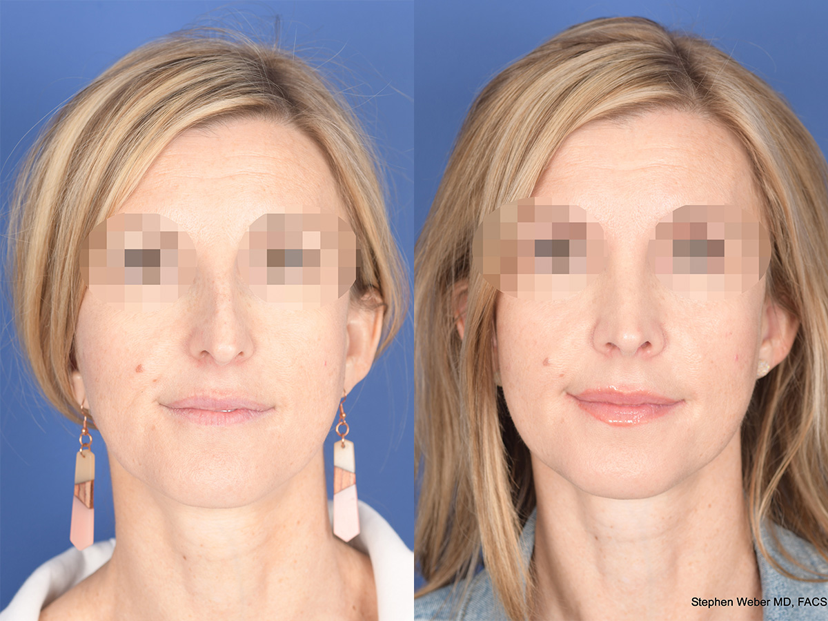 Before and After Rhinoplasty in Denver 3