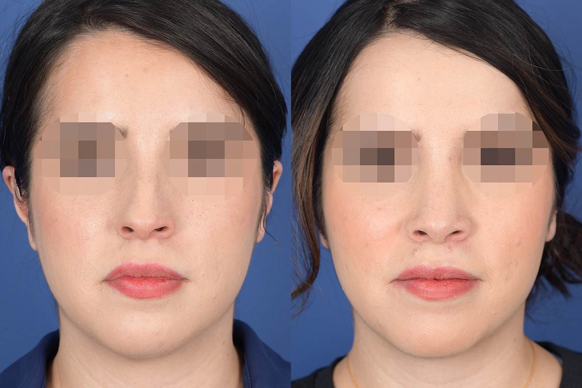 Rhinoplasty Before and After | Weber Facial Plastic Surgery