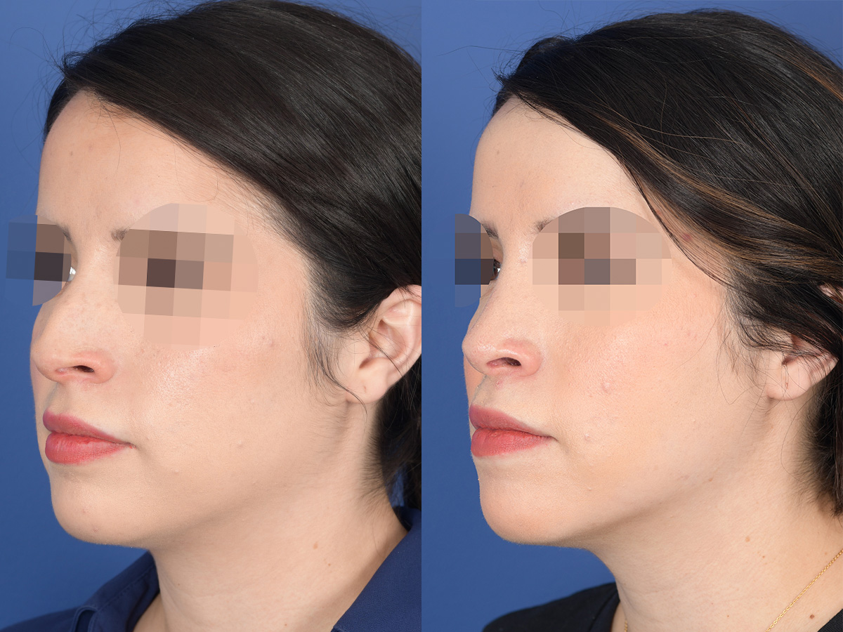 Rhinoplasty Before and After | Weber Facial Plastic Surgery