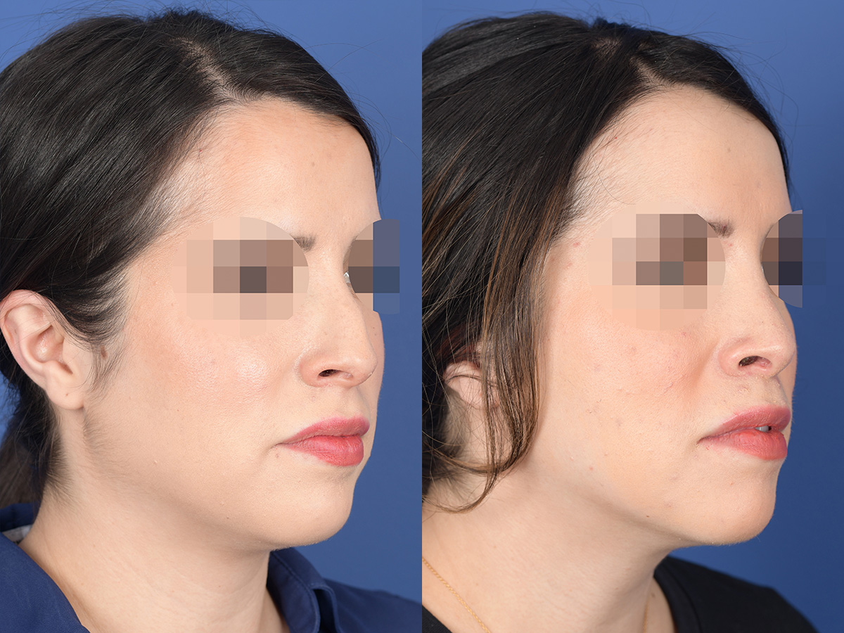 Rhinoplasty Before and After | Weber Facial Plastic Surgery