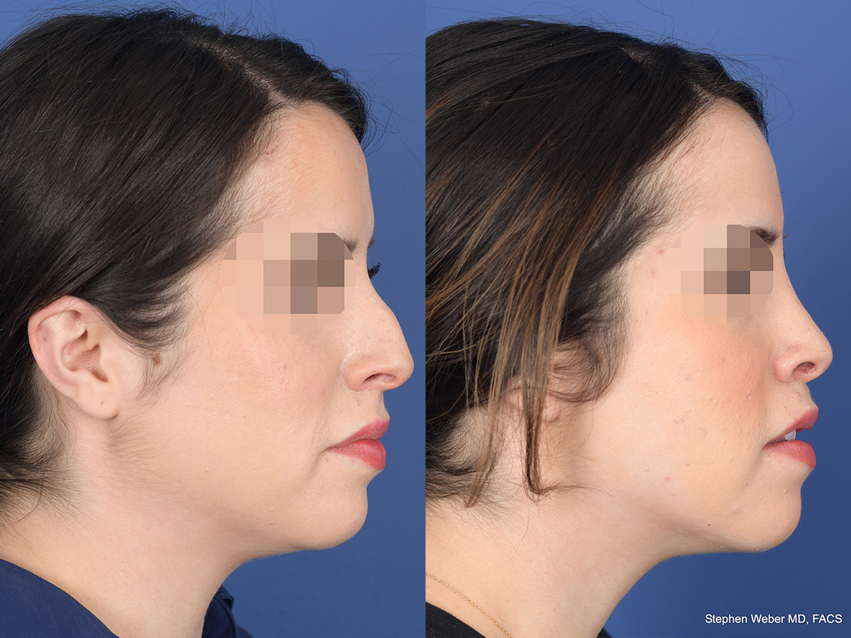 Rhinoplasty Before and After | Weber Facial Plastic Surgery