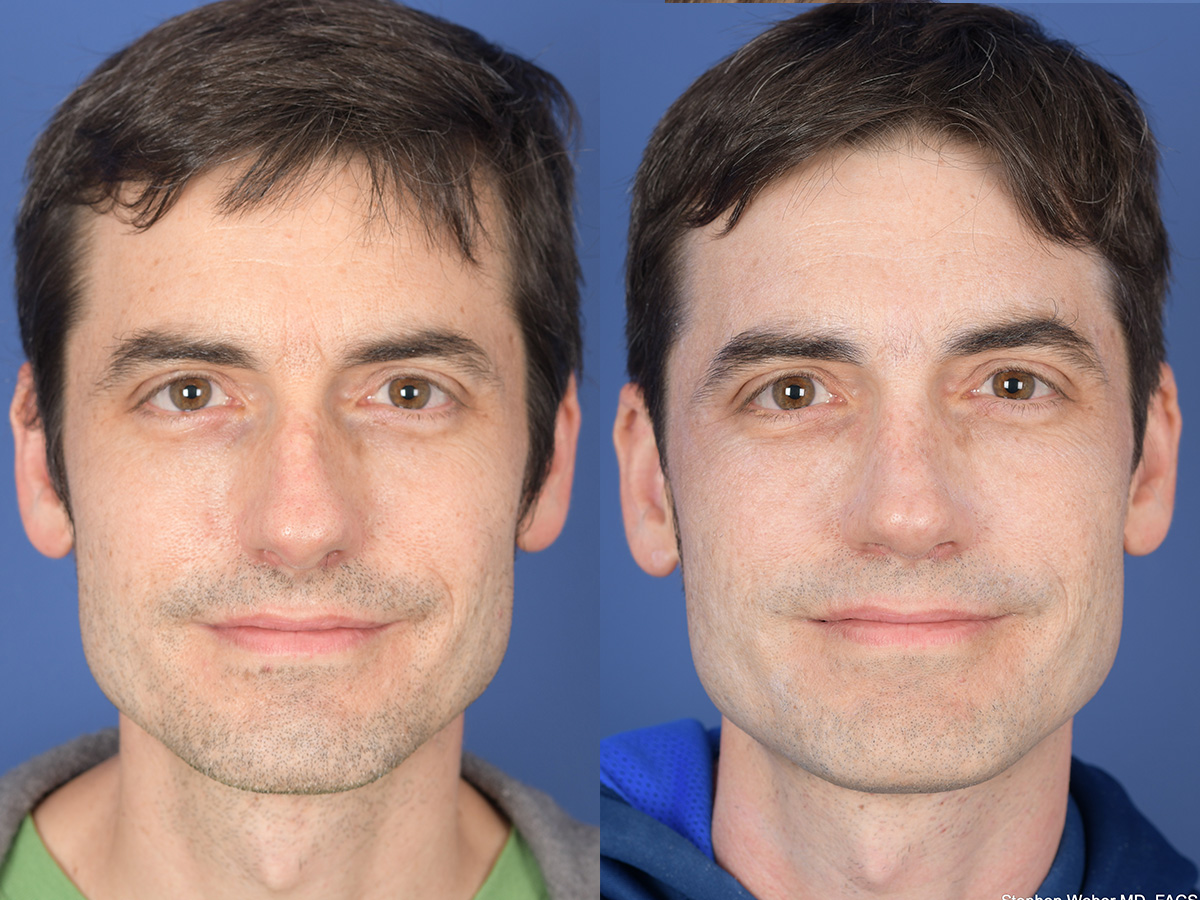 Before and After Rhinoplasty in Denver 2