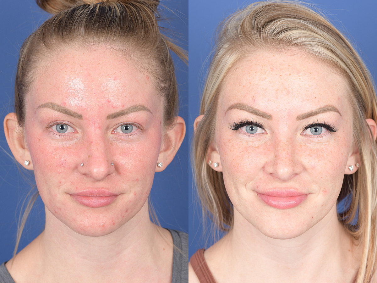 Rhinoplasty Before and After | Weber Facial Plastic Surgery
