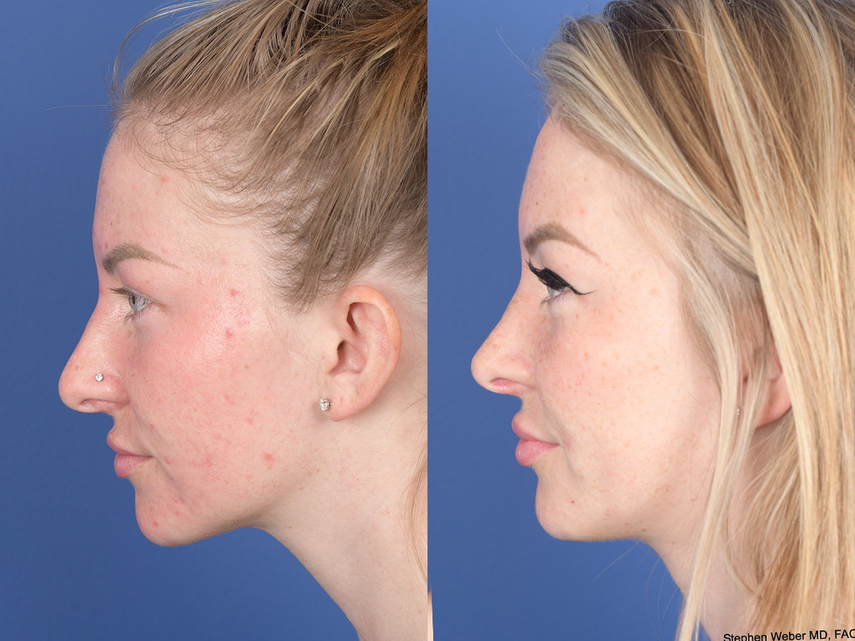 Rhinoplasty Before and After | Weber Facial Plastic Surgery