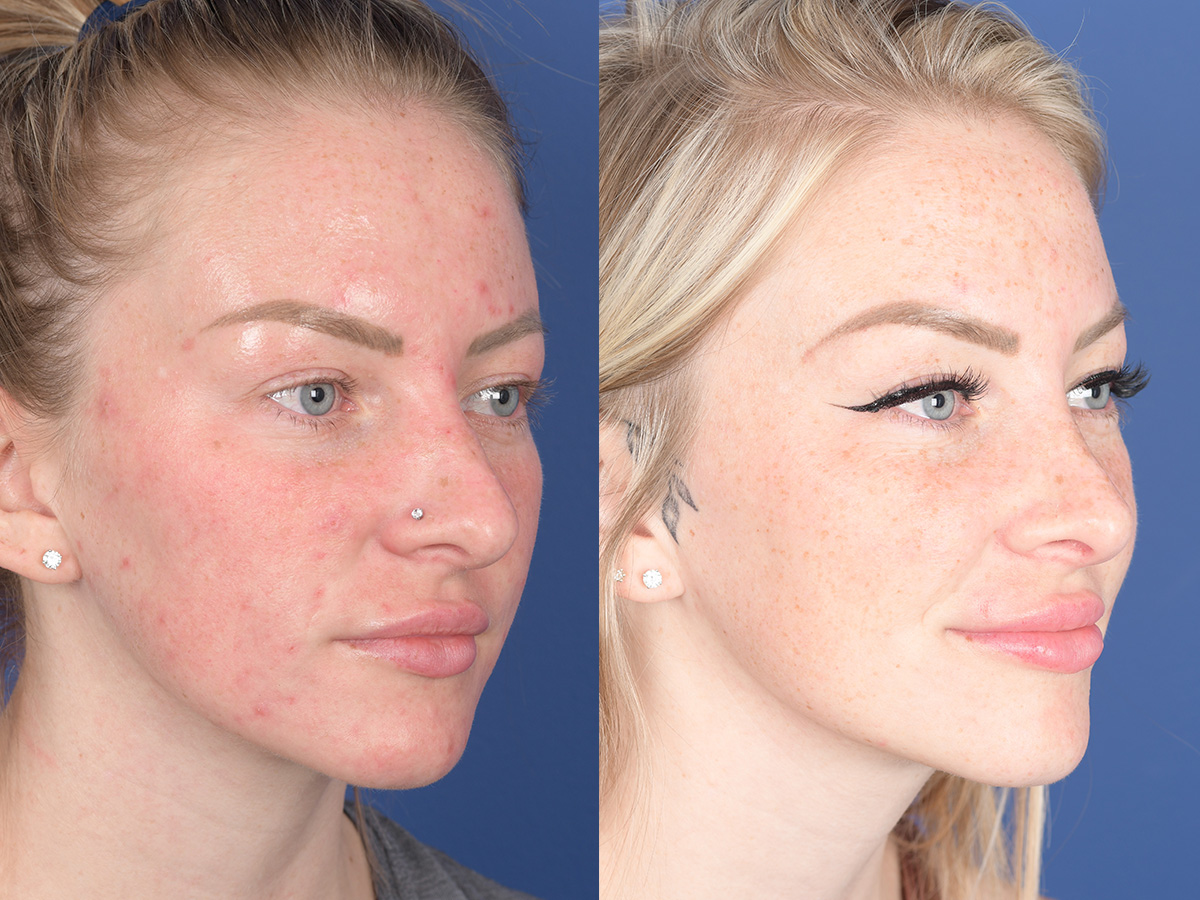 Rhinoplasty Before and After | Weber Facial Plastic Surgery