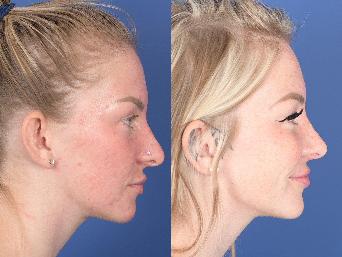 Rhinoplasty Before and After | Weber Facial Plastic Surgery