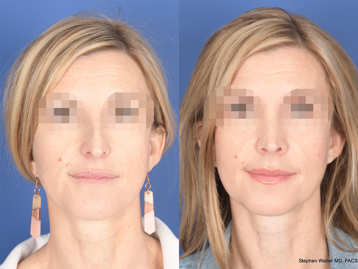 Rhinoplasty Before and After | Weber Facial Plastic Surgery