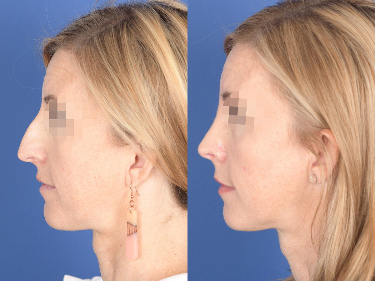 Rhinoplasty Before and After | Weber Facial Plastic Surgery