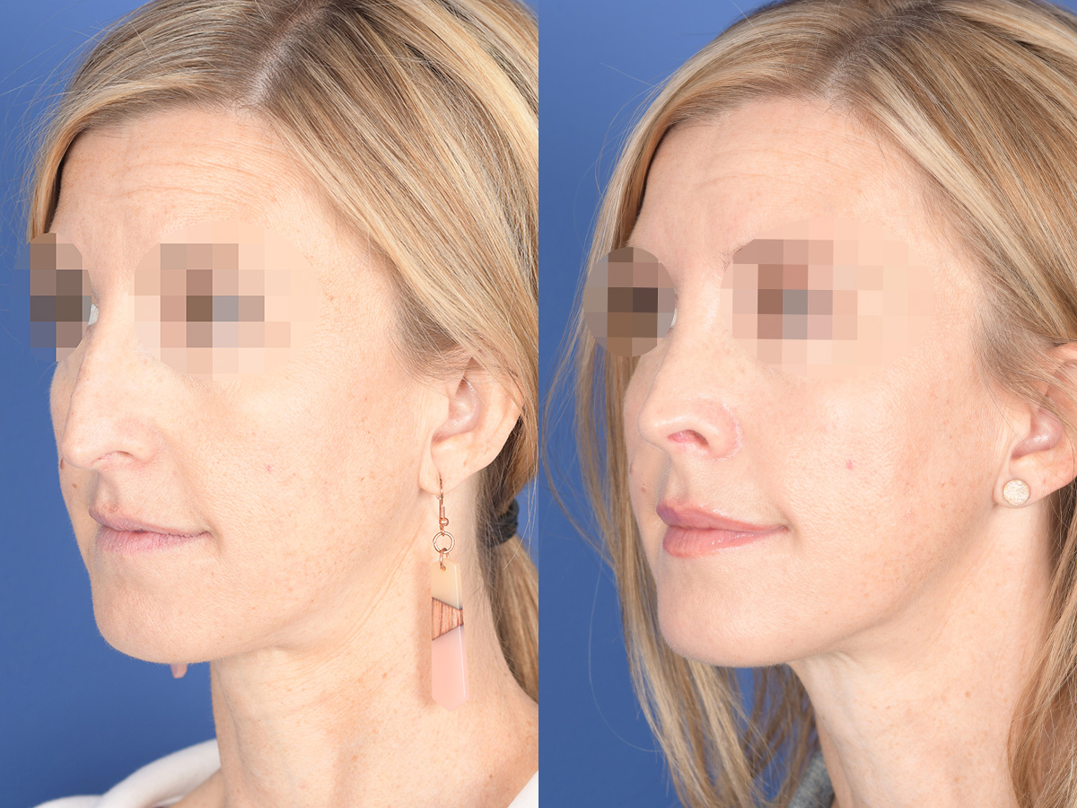 Rhinoplasty Before and After | Weber Facial Plastic Surgery