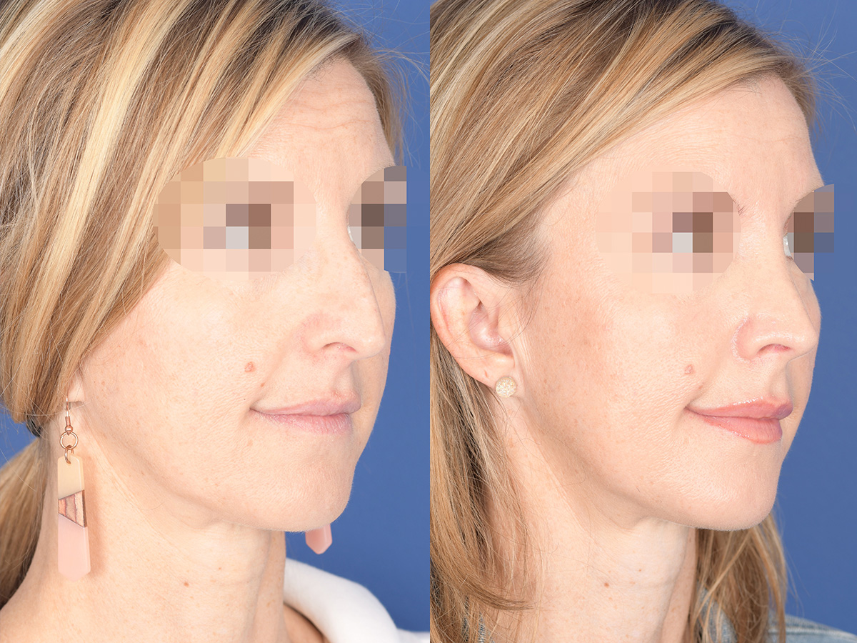 Rhinoplasty Before and After | Weber Facial Plastic Surgery