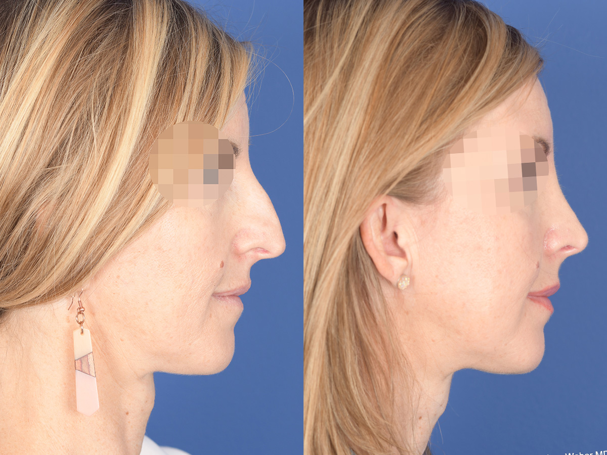 Rhinoplasty Before and After | Weber Facial Plastic Surgery