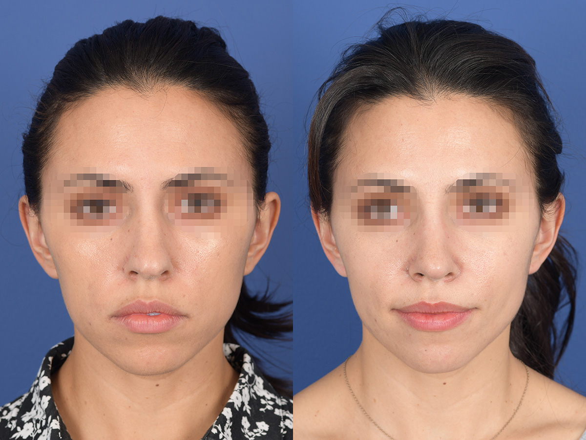 Before and After Rhinoplasty in Denver 4