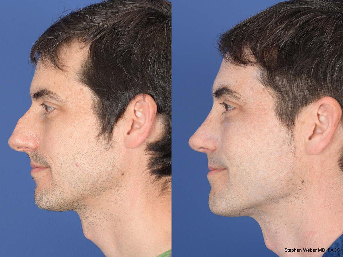 Rhinoplasty Before and After | Weber Facial Plastic Surgery