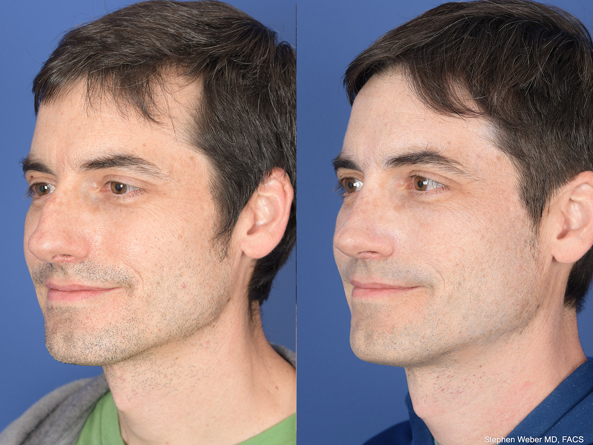 Rhinoplasty Before and After | Weber Facial Plastic Surgery