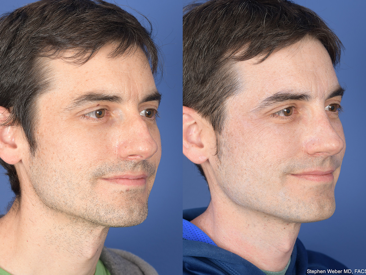 Rhinoplasty Before and After | Weber Facial Plastic Surgery