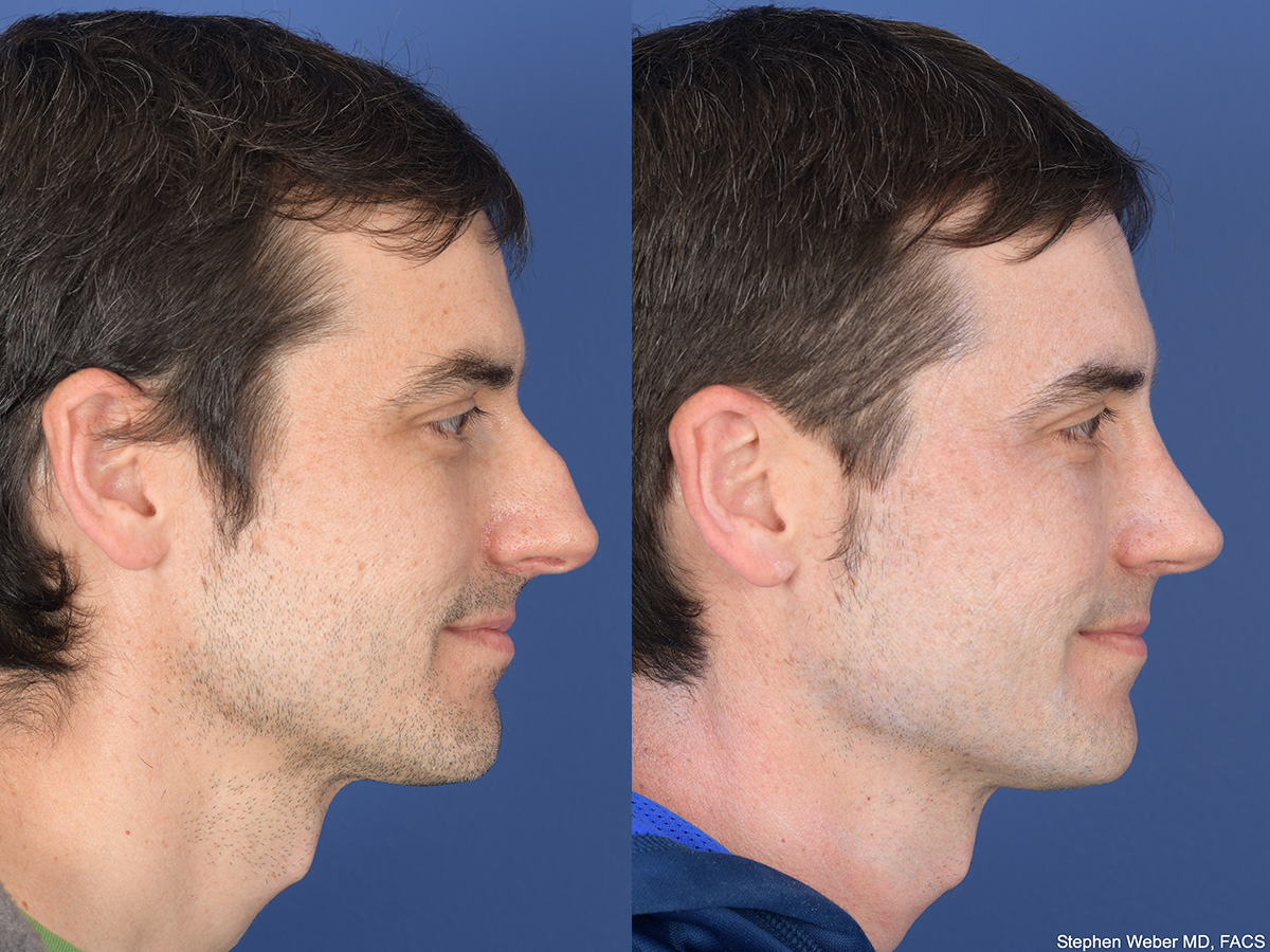 Rhinoplasty Before and After | Weber Facial Plastic Surgery