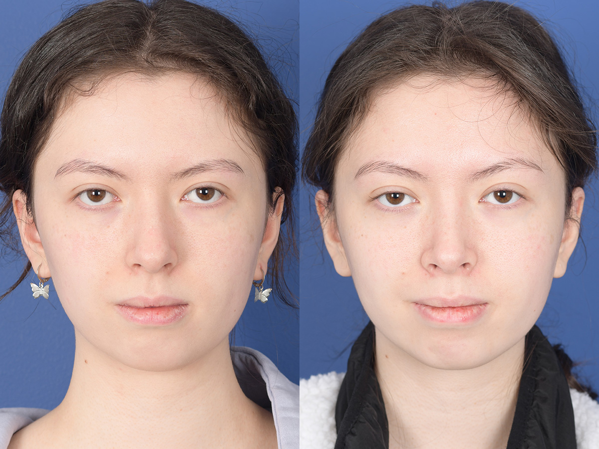 Rhinoplasty Before and After | Weber Facial Plastic Surgery