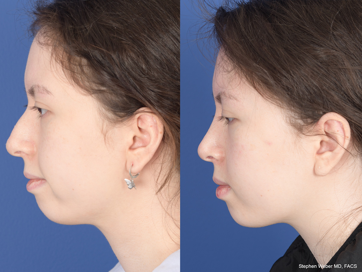 Rhinoplasty Before and After | Weber Facial Plastic Surgery