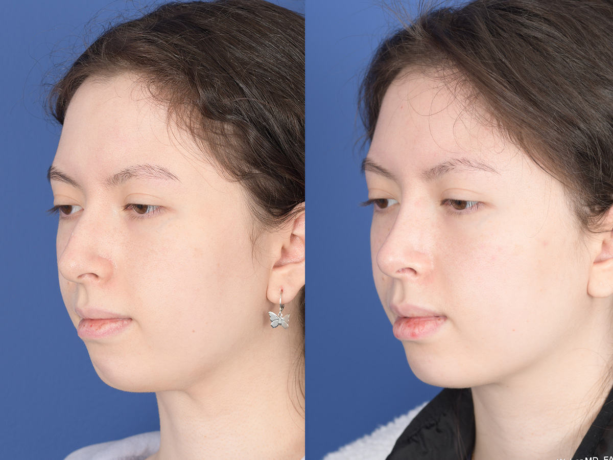 Rhinoplasty Before and After | Weber Facial Plastic Surgery