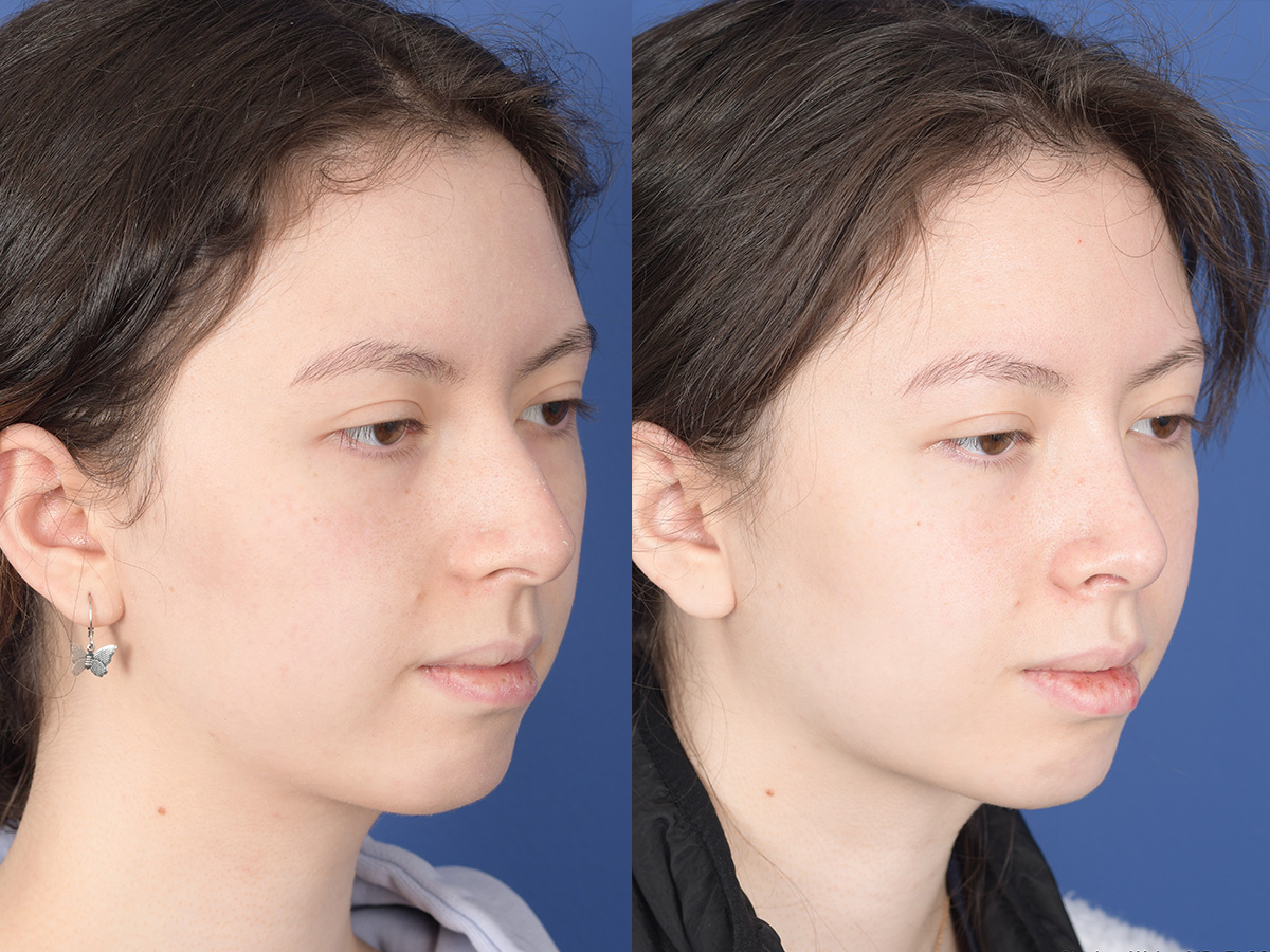 Rhinoplasty Before and After | Weber Facial Plastic Surgery