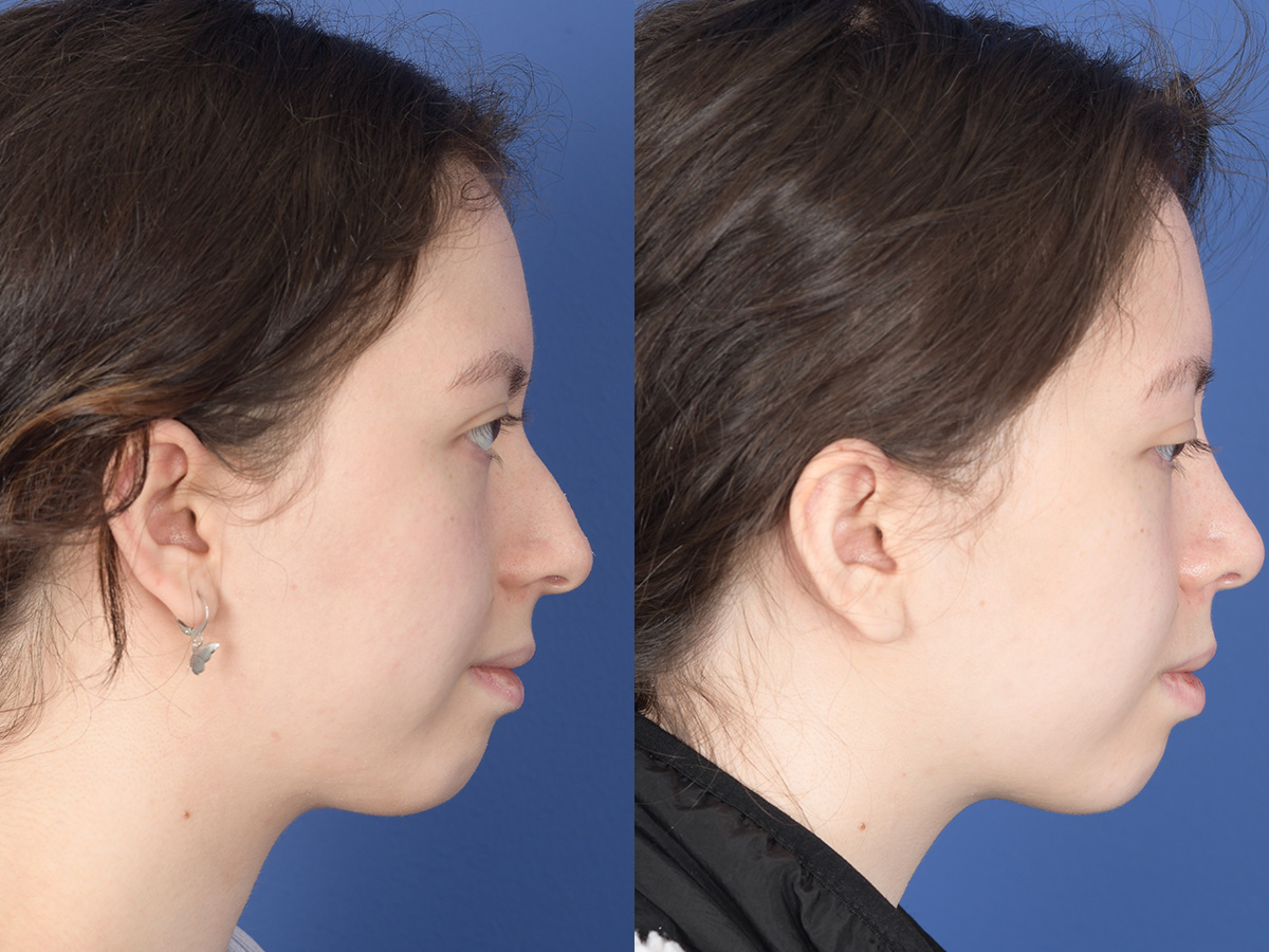 Rhinoplasty Before and After | Weber Facial Plastic Surgery