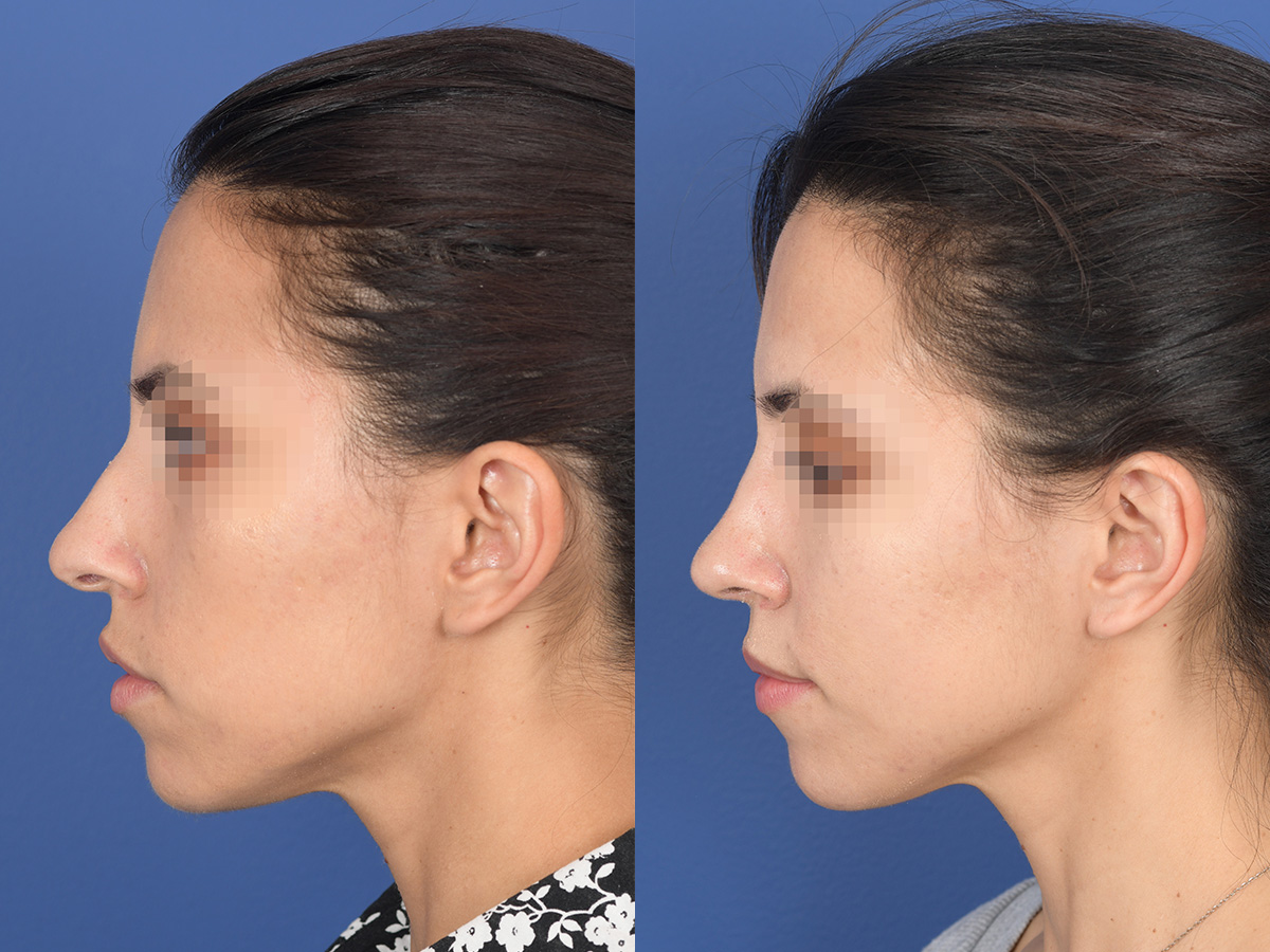 Rhinoplasty Before and After | Weber Facial Plastic Surgery
