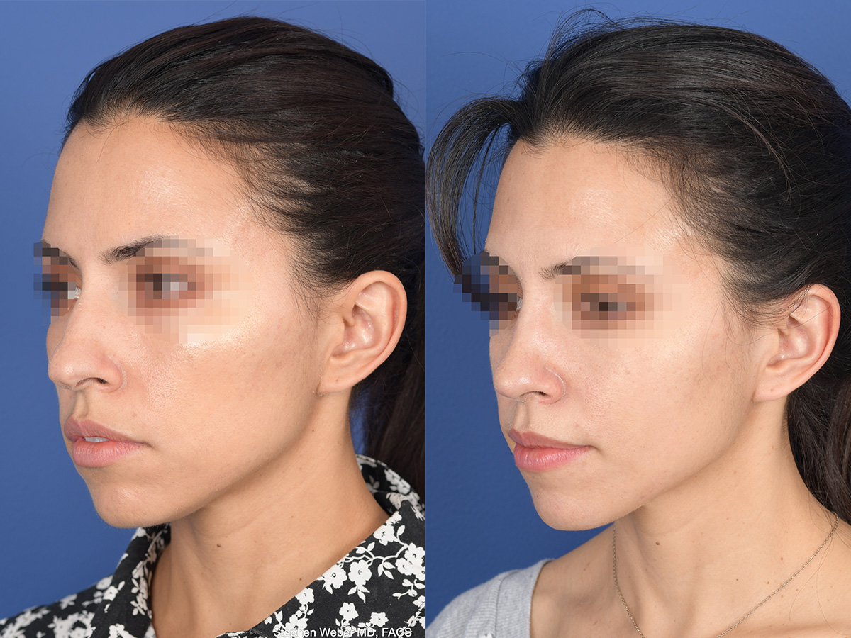 Rhinoplasty Before and After | Weber Facial Plastic Surgery