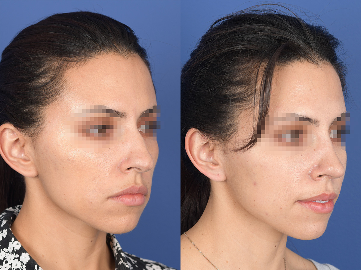 Rhinoplasty Before and After | Weber Facial Plastic Surgery