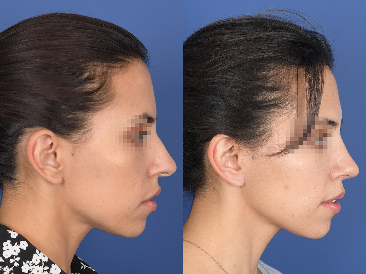 Rhinoplasty Before and After | Weber Facial Plastic Surgery