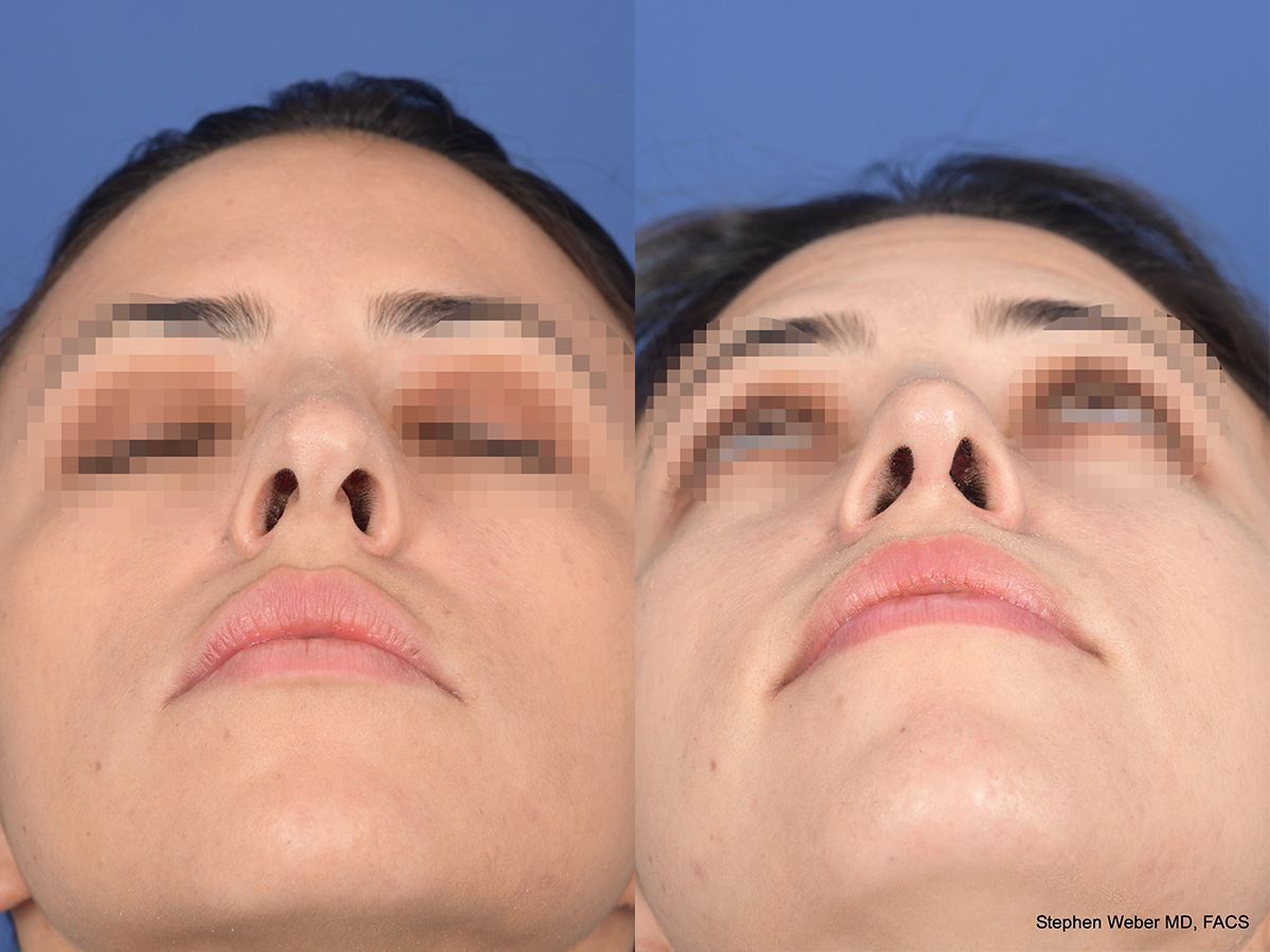 Rhinoplasty Before and After | Weber Facial Plastic Surgery