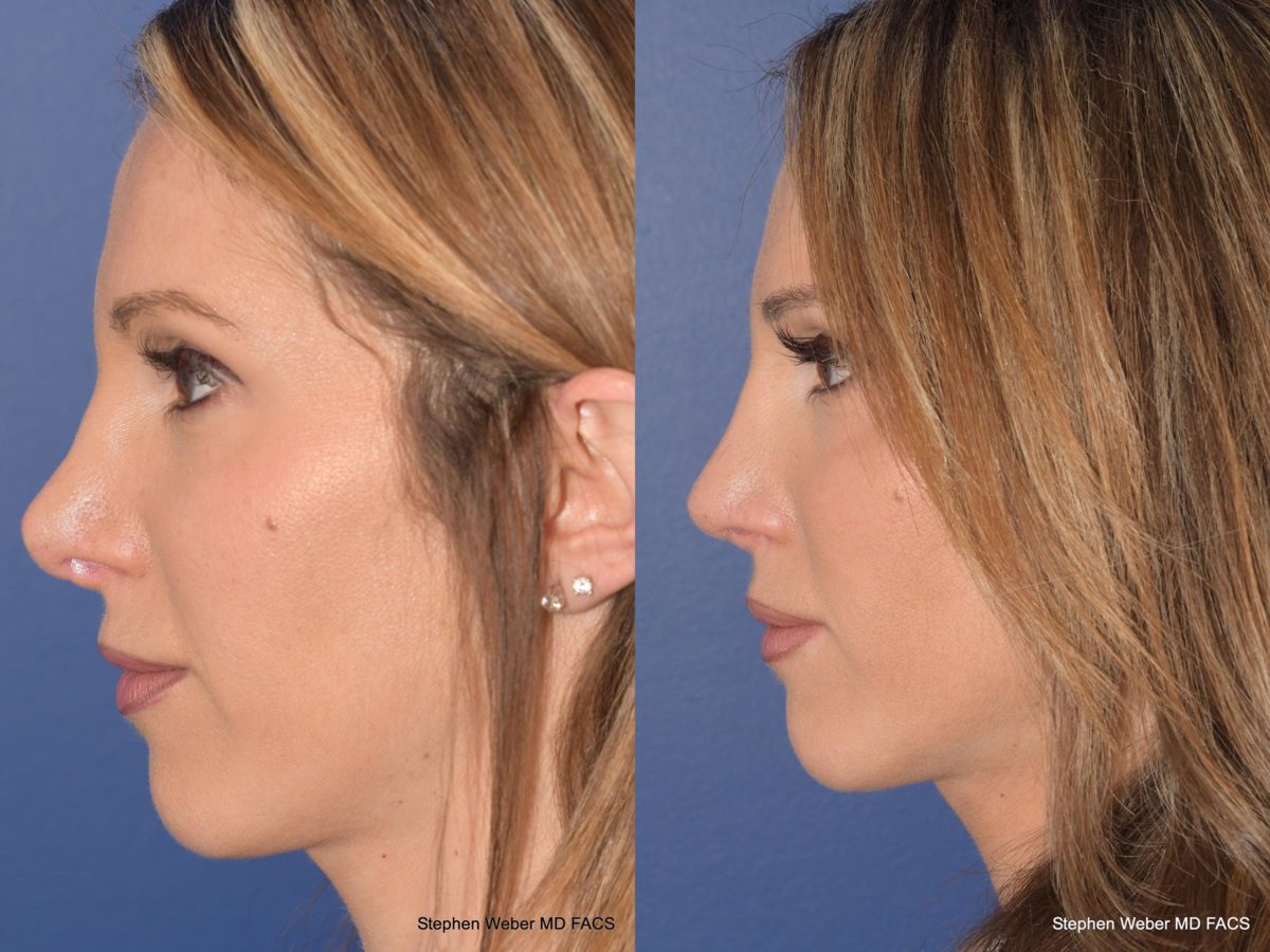 Rhinoplasty Before and After | Weber Facial Plastic Surgery
