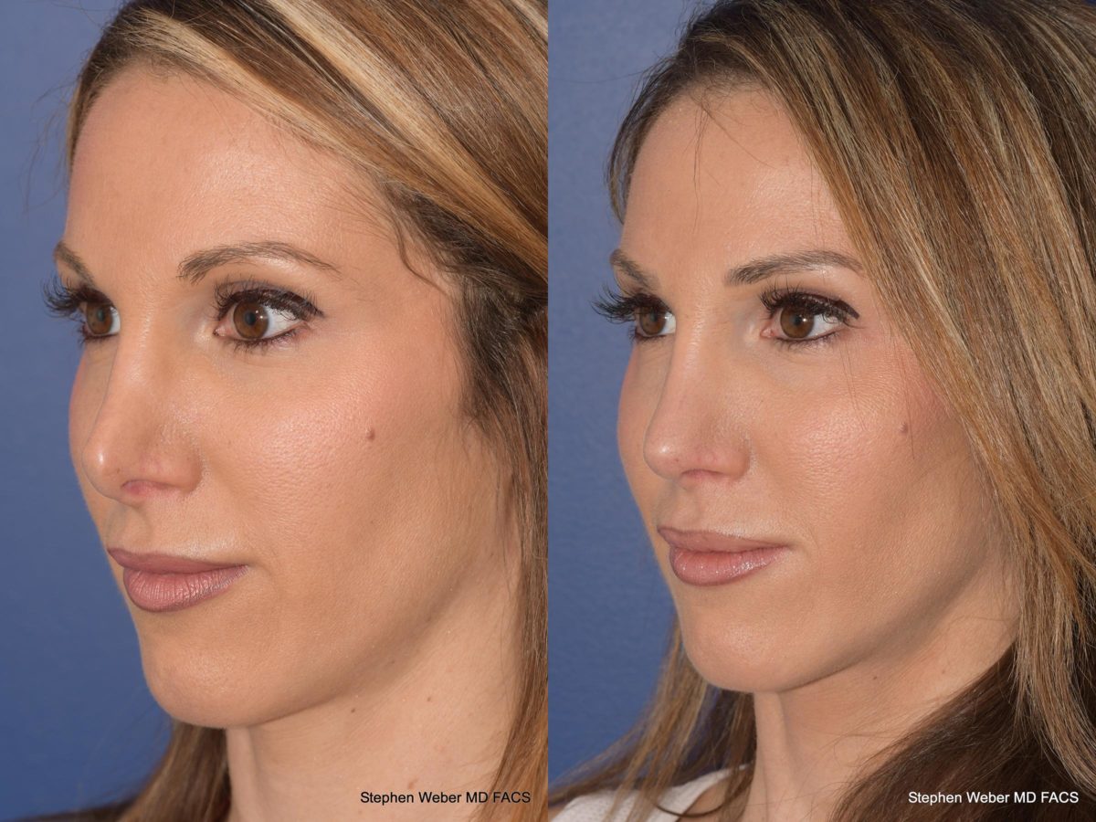 Rhinoplasty Before and After | Weber Facial Plastic Surgery