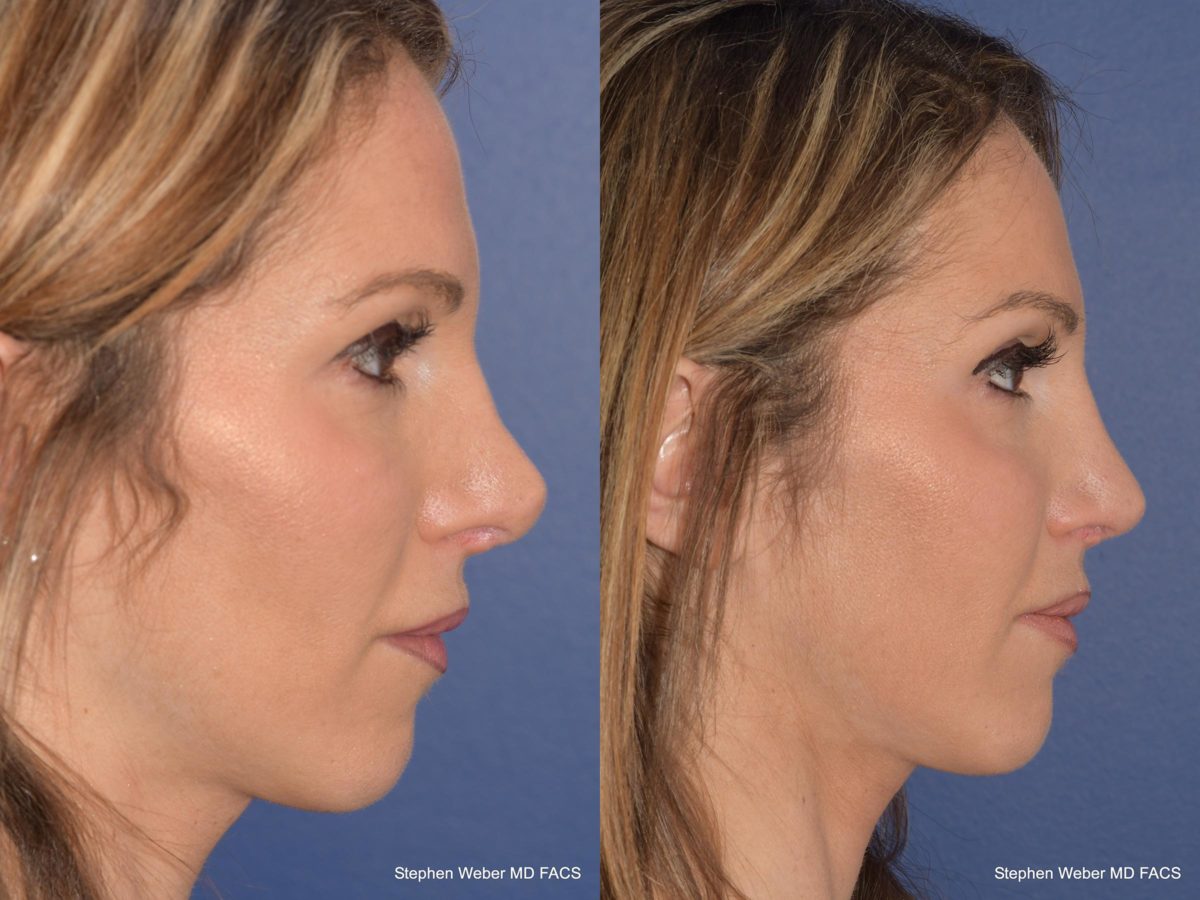 Rhinoplasty Before and After | Weber Facial Plastic Surgery