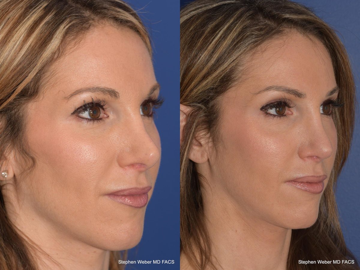 Rhinoplasty Before and After | Weber Facial Plastic Surgery