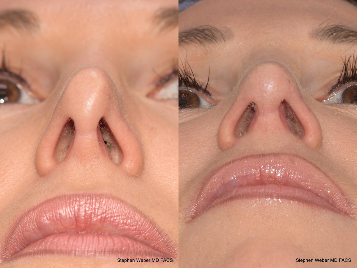 Rhinoplasty Before and After | Weber Facial Plastic Surgery