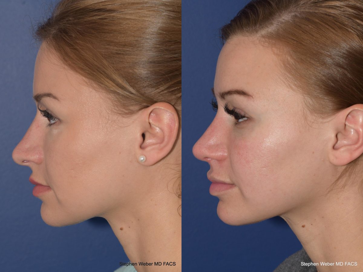 Rhinoplasty Before and After | Weber Facial Plastic Surgery