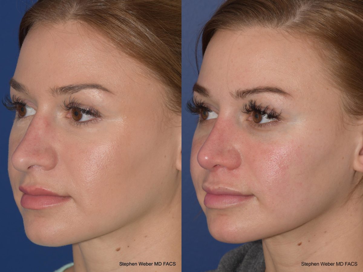 Rhinoplasty Before and After | Weber Facial Plastic Surgery