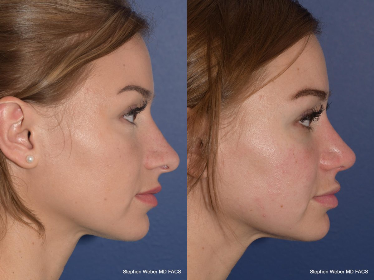Rhinoplasty Before and After | Weber Facial Plastic Surgery