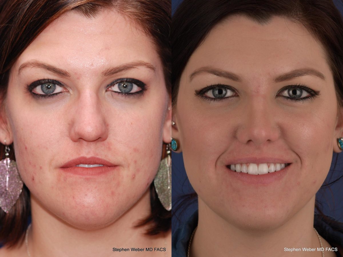 Rhinoplasty Before and After | Weber Facial Plastic Surgery