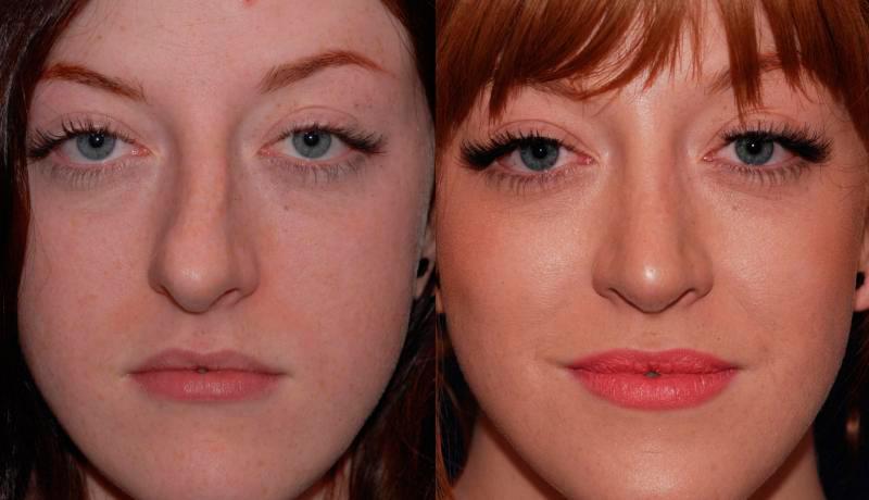 Rhinoplasty Before and After | Weber Facial Plastic Surgery