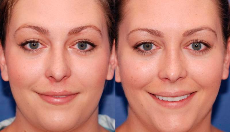 Rhinoplasty Before and After | Weber Facial Plastic Surgery
