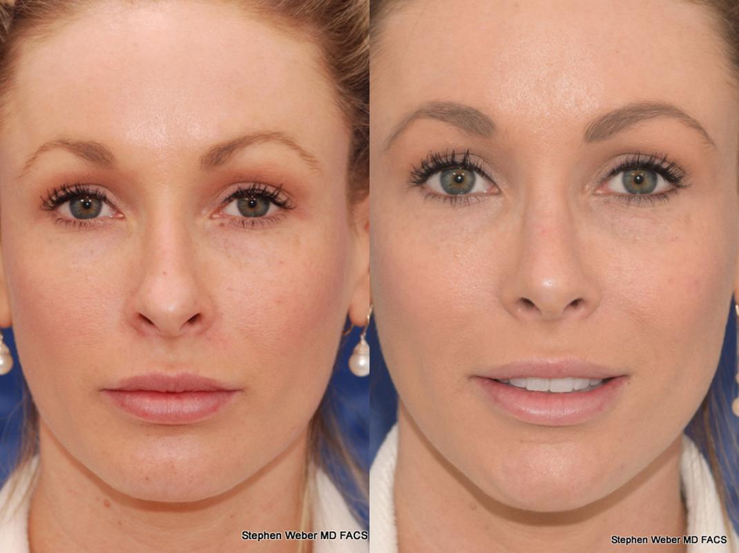 Rhinoplasty Before and After | Weber Facial Plastic Surgery