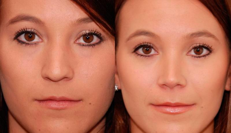 Rhinoplasty Before and After | Weber Facial Plastic Surgery