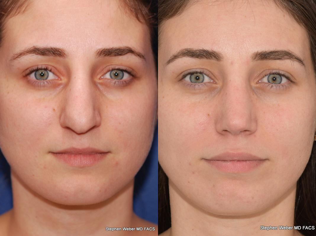 Rhinoplasty Before and After | Weber Facial Plastic Surgery